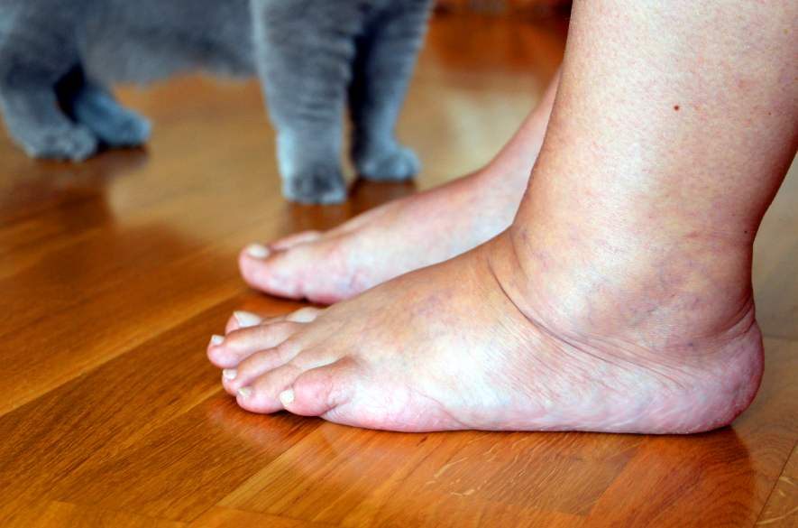 Pés inchados - problema de circulação